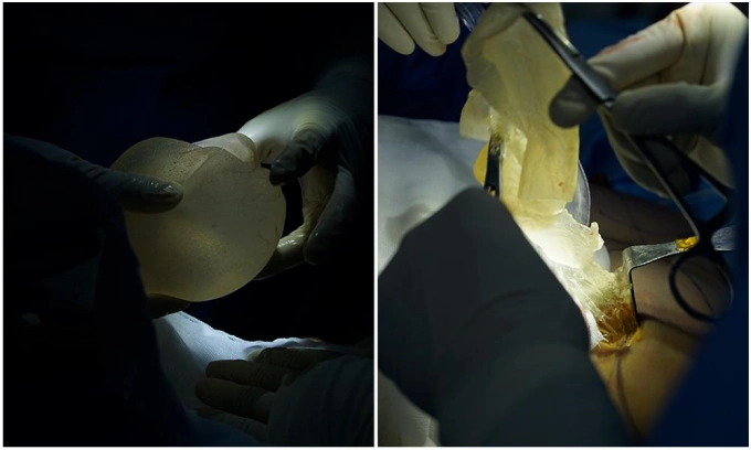 In a case of CUI textured breast implant removal after 15 years, the left implant has ruptured while the right implant remains intact. Photo courtesy of Dung Ho