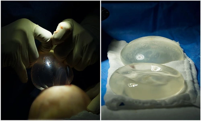 Many cases of breast implants placed for around 20 years show that the implants remain intact and do not exhibit signs of aging. Photo courtesy of ???