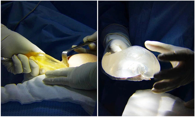 The right breast implant (275cc) has ruptured, with the gel turning yellow, while the left breast implant (300cc) remains intact in both its shell and gel. Photo courtesy of ???