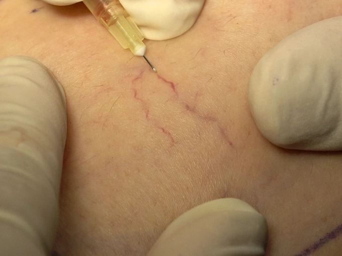 Sclerotherapy for the treatment of reticular veins. Photo courtesy of Dr. Vein