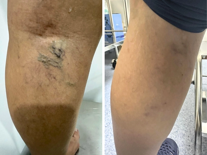 Results after treatment with Sclaser. Photo courtesy of Dr. Vein
