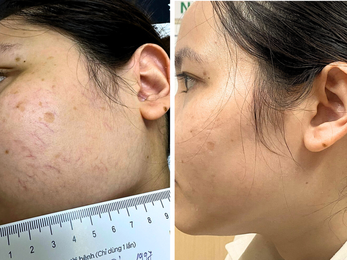 Results after treatment with Dual Cool Laser. Photo courtesy of Dr. Vein