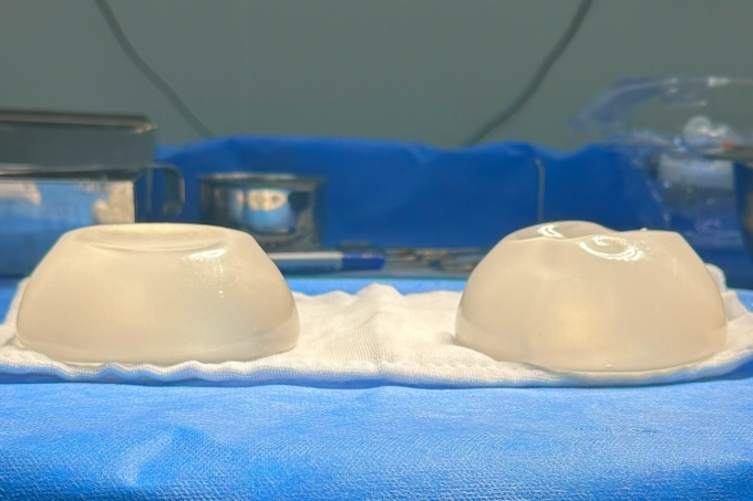 Breast implant removal surgery is not a simple procedure. Photo courtesy of Dung Ho