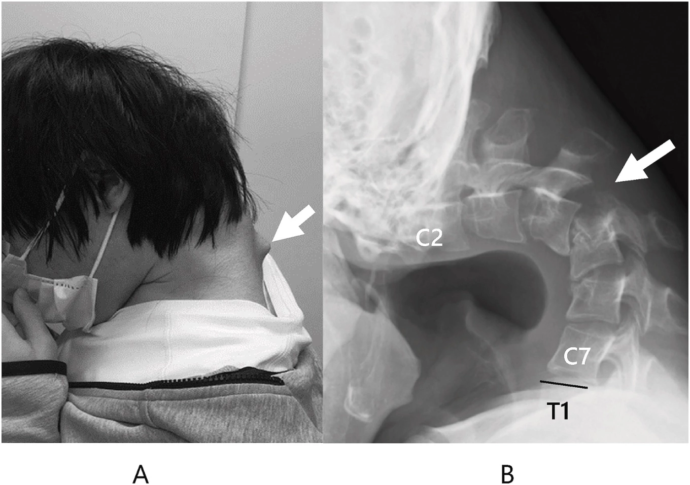 Man develops dropped head syndrome after nonstop phone use - VnExpress International