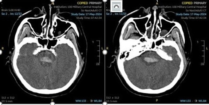 CT scan of the brain of a patient with stroke due to high blood pressure. Photo courtesy of the hospital